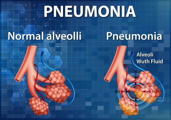 Comparação Alvéolos Saudáveis Ilustração Pneumonia — Vetor de Stock