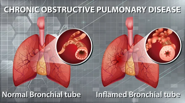 说明慢性阻塞性肺病 — 图库矢量图片