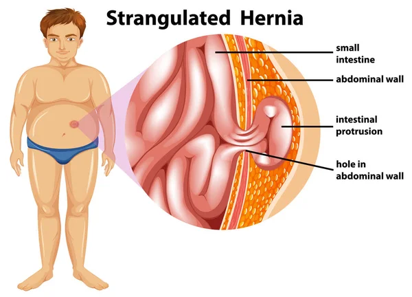 Man Strangulated Hernia Diagrama Ilustração —  Vetores de Stock