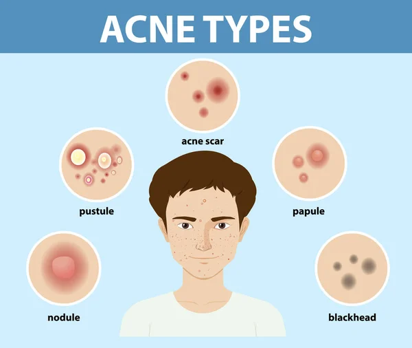 Soorten Acne Huid Puistjes Illustratie — Stockvector