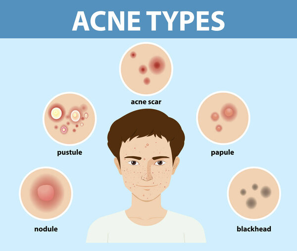 Types of acne on the skin or pimples illustration