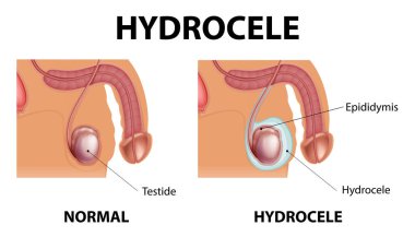Medical poster showing different between male normal testicle and hydrocele illustration