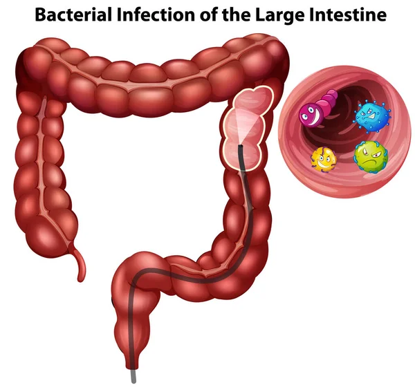 Infección Bacteriana Del Intestino Grueso Ilustración — Archivo Imágenes Vectoriales