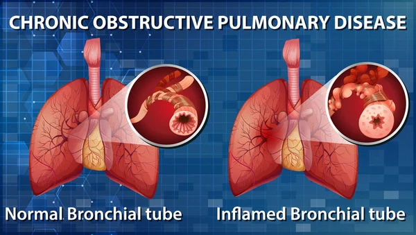 Illustration Des Maladies Pulmonaires Obstructives Chroniques — Image vectorielle