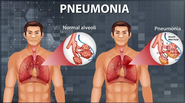 Anatomia Humana Mostrando Pneumonia Ilustração — Vetor de Stock