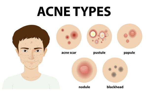 Types of acne on the skin or pimples illustration
