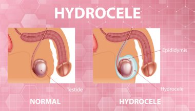 Medical poster showing different between male normal testicle and hydrocele illustration