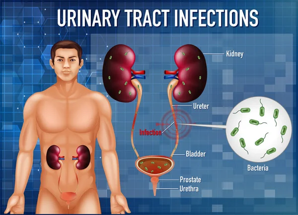 Informativní Ilustrace Infekce Močových Cest Ilustrace — Stockový vektor