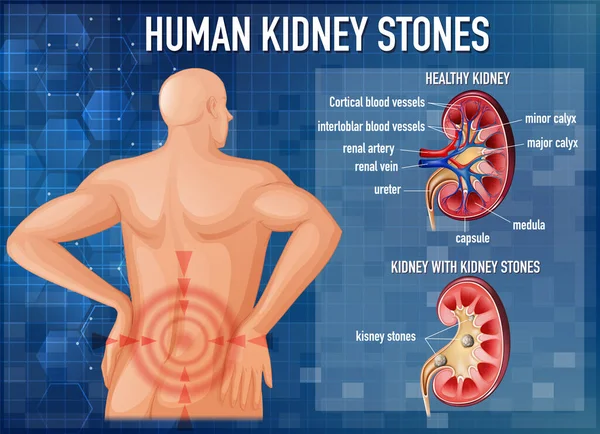 Σύγκριση Των Υγιών Νεφρών Και Των Νεφρών Πέτρες Απεικόνιση — Διανυσματικό Αρχείο