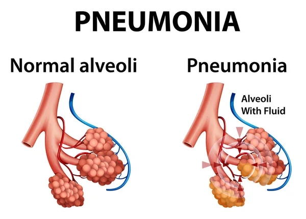 Anatomie Humaine Montrant Une Pneumonie Illustration — Image vectorielle