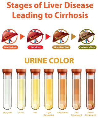Siroz illüstrasyonuna yol açan karaciğer hastalığının aşamaları