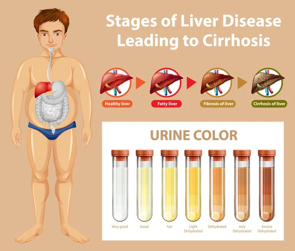 Етапи Захворювань Печінки Призводять Ілюстрації Цирозу — стоковий вектор