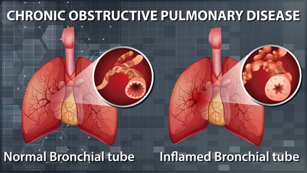 Chronic Obstructive Pulmonary Disease Illustration — Stock Vector