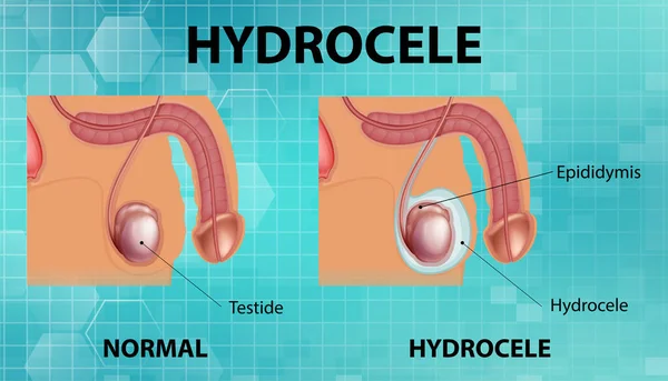 Affiche Médicale Montrant Différent Entre Testicule Normal Mâle Illustration Hydrocèle — Image vectorielle