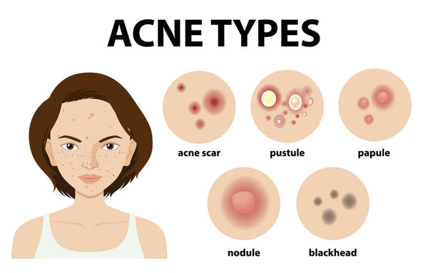 Types of acne on the skin or pimples illustration