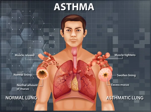 Comparação Pulmão Saudável Ilustração Pulmão Asmático — Vetor de Stock