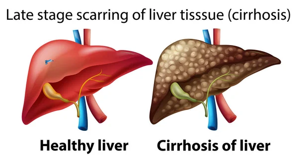 肝脏显示的晚期疤痕 — 图库矢量图片