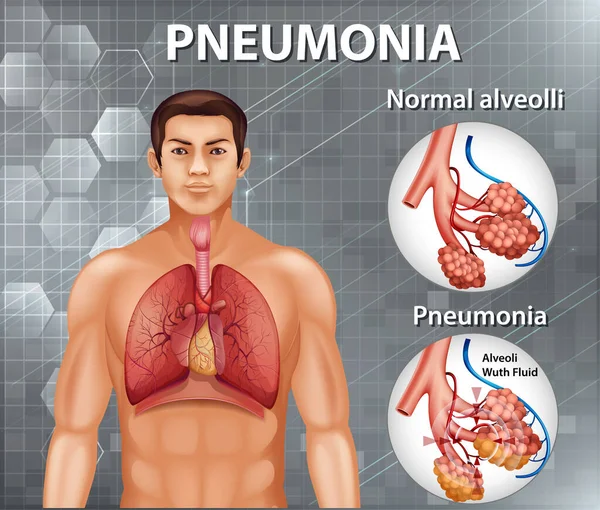 Comparação Alvéolos Saudáveis Ilustração Pneumonia — Vetor de Stock