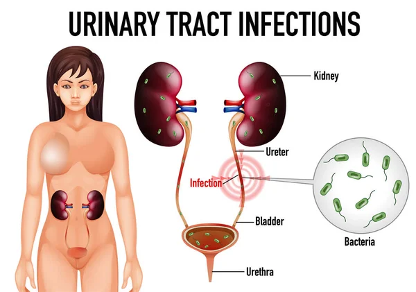 Cartaz Informação Infecções Trato Urinário Ilustração — Vetor de Stock