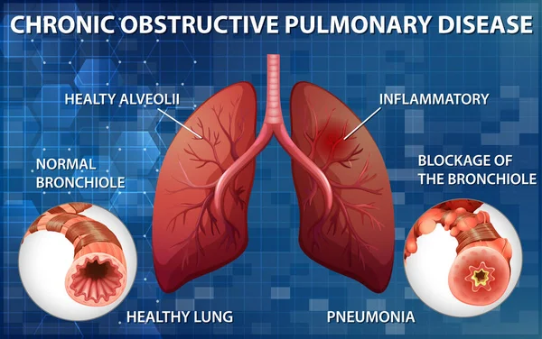 Pulmón Con Enfermedad Pulmonar Obstructiva Crónica Ilustración — Vector de stock