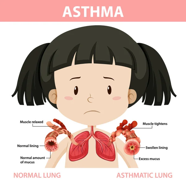 Asthma Diagramm Mit Normaler Lunge Und Asthmatischer Lungenillustration — Stockvektor