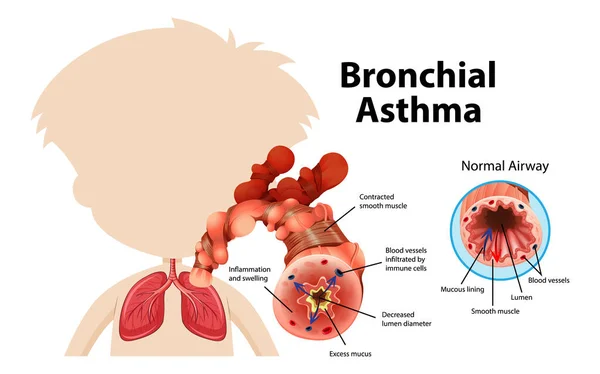 Диаграмма Бронхиальной Астмы Нормальной Иллюстрацией Дыхательных Путей Астматических Дыхательных Путей — стоковый вектор