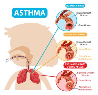 Astım diyagramı, normal hava yolu ve astım illüstrasyonu.