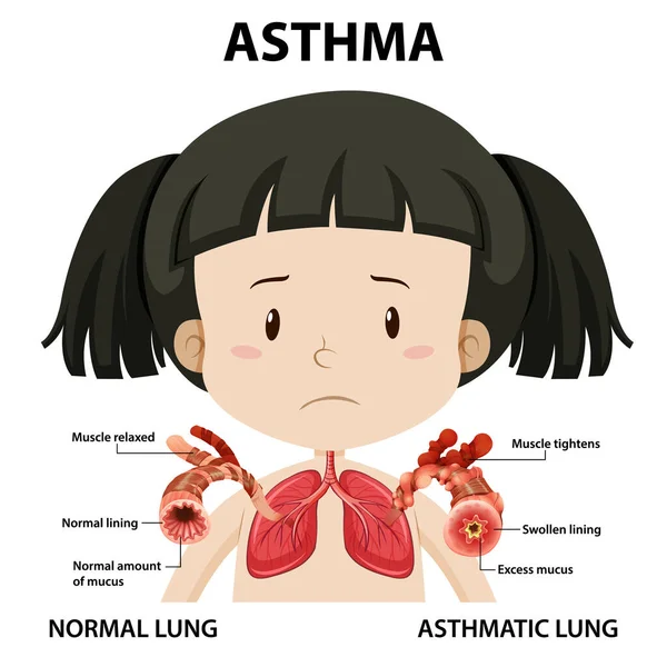 Diagrama Asma Com Pulmão Normal Ilustração Pulmonar Asmática — Vetor de Stock