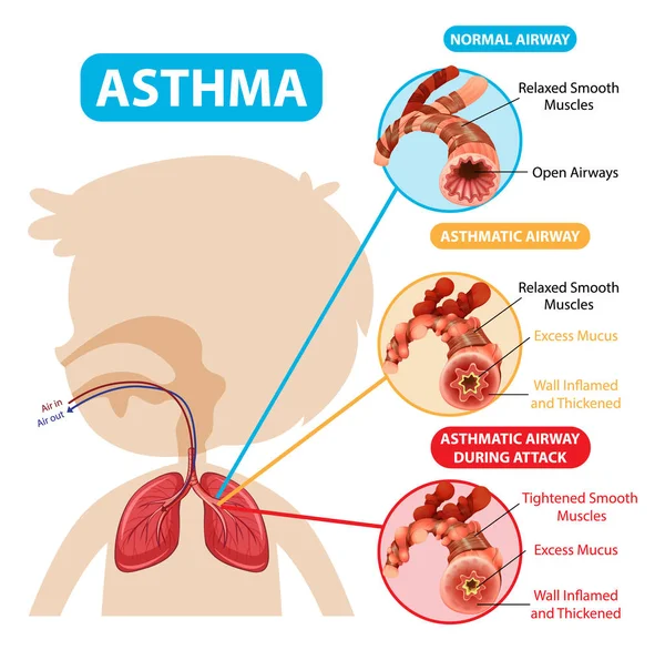 Diagramme Asthme Avec Illustration Normale Des Voies Respiratoires Des Voies — Image vectorielle
