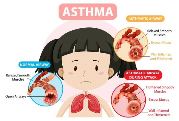 具有正常气道和哮喘气道图解的哮喘图 — 图库矢量图片