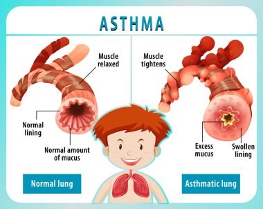 Astım diyagramı ve normal akciğer ve astım çizelgesi.