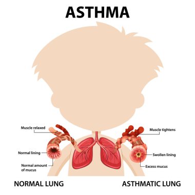 Bronşiyal astım diyagramı ve normal akciğer ve astım çizimi.