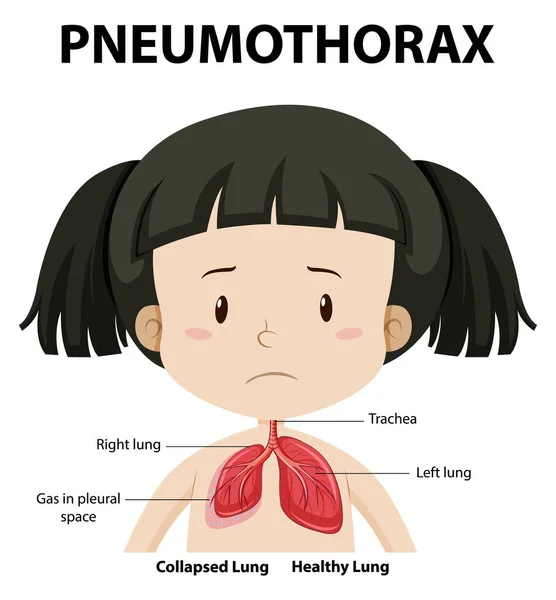 55 Pneumothorax Stock Illustrations | Depositphotos® 55 Pneumothorax Stock Illustrations | Depositphotos®