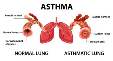 Astım diyagramı ve normal akciğer ve astım çizelgesi.