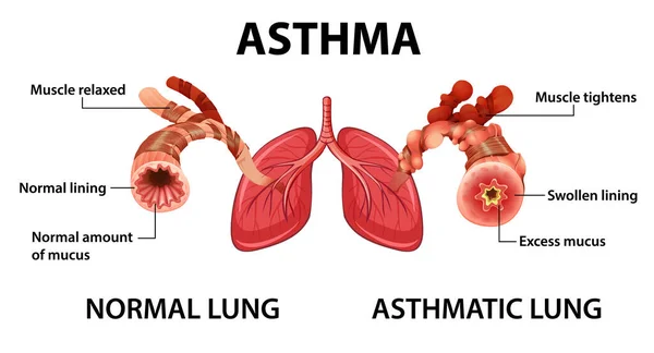 Diagrama Del Asma Con Ilustración Normal Pulmón Pulmón Asmático — Archivo Imágenes Vectoriales