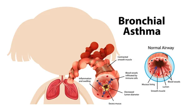 Bronkial Astmadiagram Med Normal Luftväg Och Astmatisk Luftvägsillustration — Stock vektor