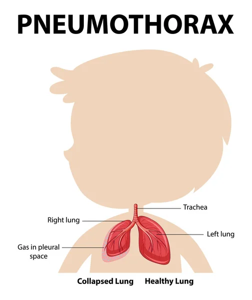 Pneumothorax Diagram Van Menselijke Anatomie Illustratie — Stockvector