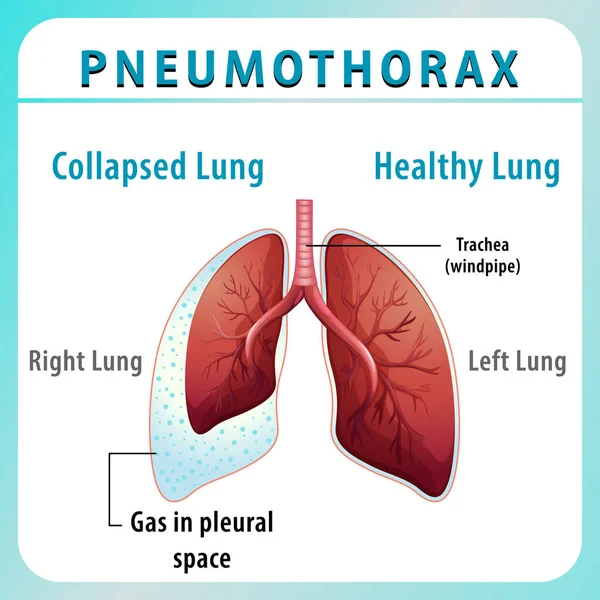 Diagrama Pneumotórax Com Pulmão Colapsado Ilustração Pulmonar Saudável — Vetor de Stock