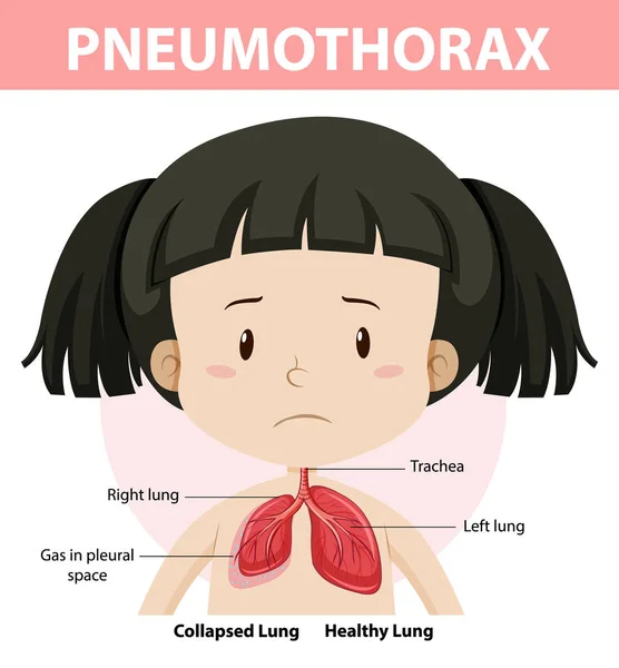 Diagrama Neumotórax Anatomía Humana Ilustración — Vector de stock