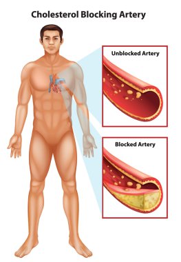 Ateriosclerosis