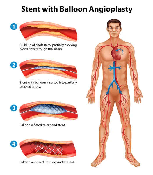 Stent angioplasty procedure — Stock Vector