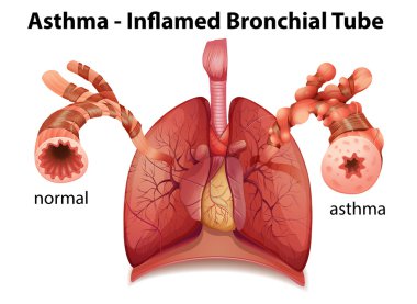 Bronchial asthma clipart