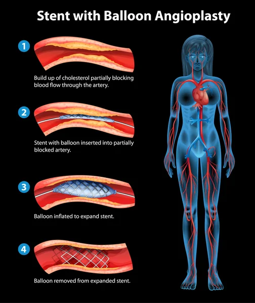 Stent anjiyoplasti işlemi — Stok Vektör