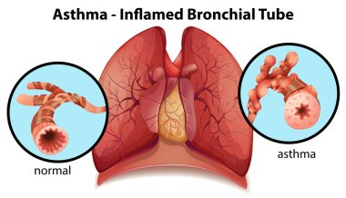 An asthma-inflamed bronchial tube clipart