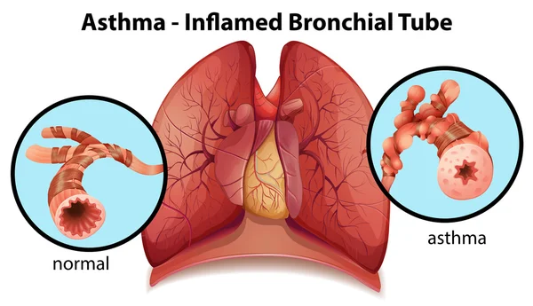 Un tubo bronquial inflamado por el asma — Archivo Imágenes Vectoriales