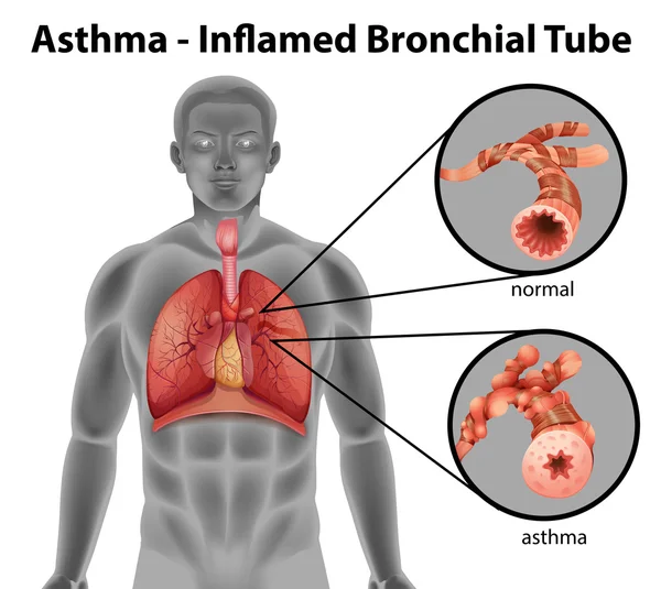 Tubo bronquial inflamado por asma — Vector de stock