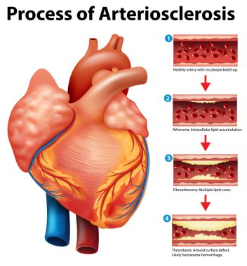 Process of Arteriosclerosis clipart