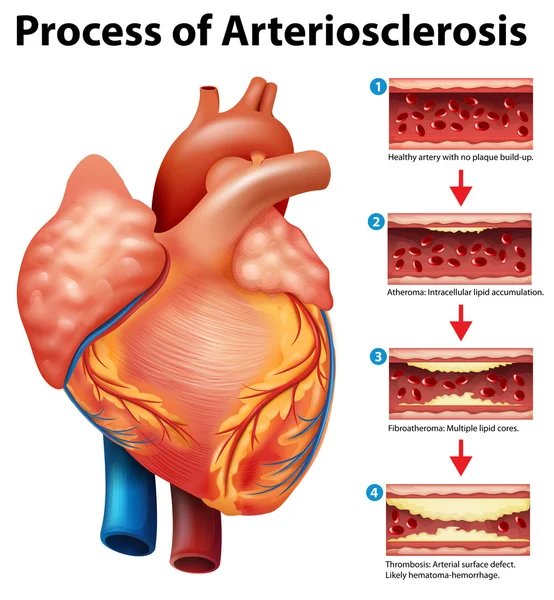 Prozess der Arteriosklerose — Stockvektor