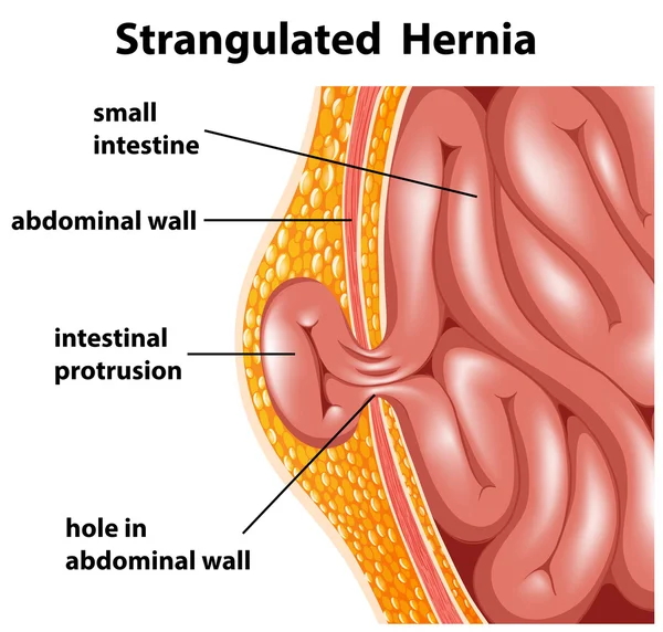 Hernia estrangulada — Vector de stock