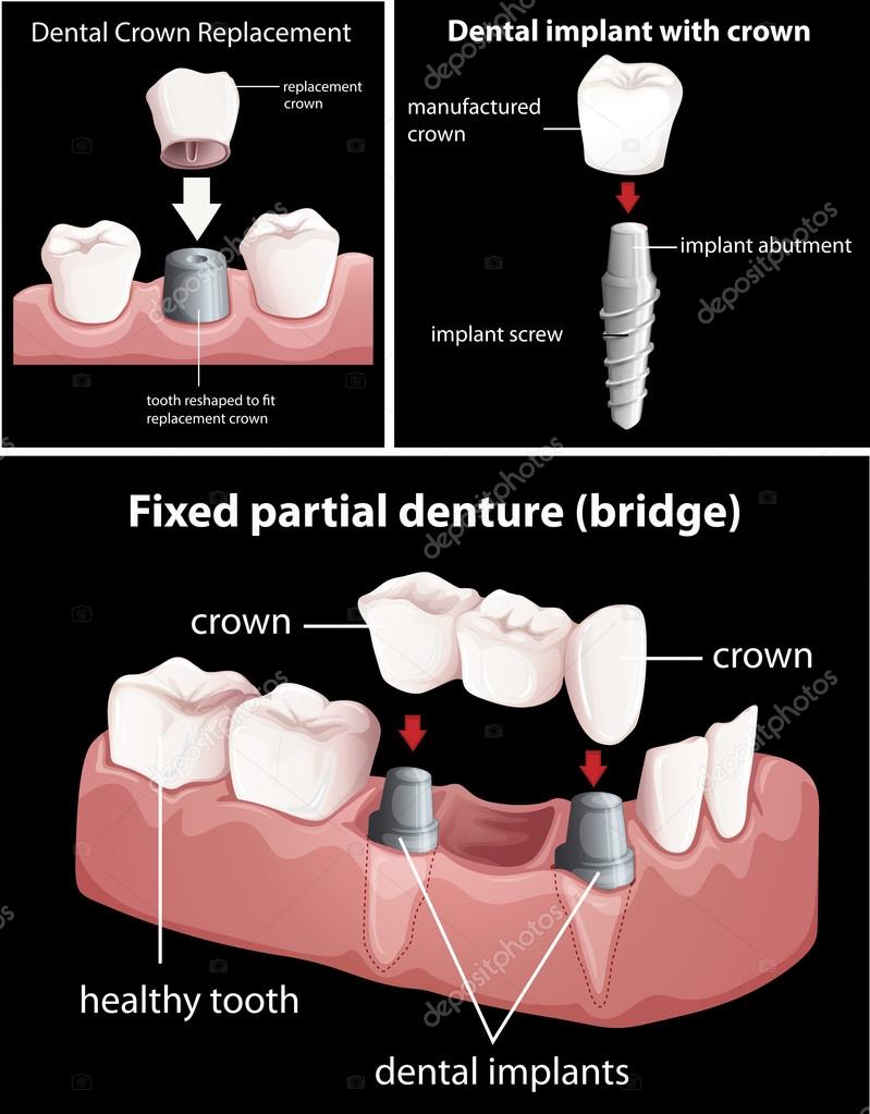 Dental procedures on black Stock Vector Image by ©blueringmedia 80125866